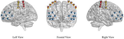 Decrease in walking ability with increased functional connectivity between multiple brain areas in Parkinson’s disease: a functional near-infrared spectroscopy study